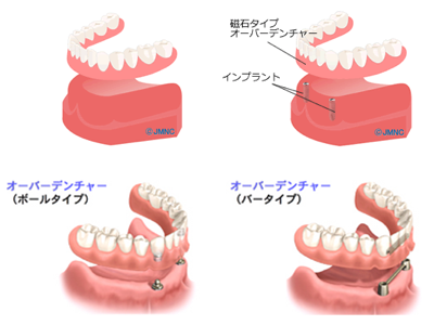 入れ歯の補強